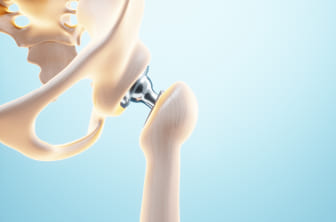 Prótesis de cadera o Artroplastia de cadera