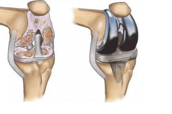 Prótesis de rodilla o Artroplastia de rodilla